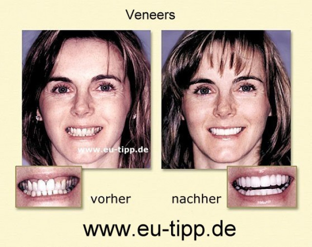 NEUE ZÄHNE in Tschechien - Implantate € 490 - Wellness Gesundheit - 